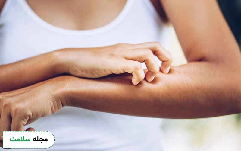 پماد پروتوپیک برای راش پوستی می تواند موثر باشد.