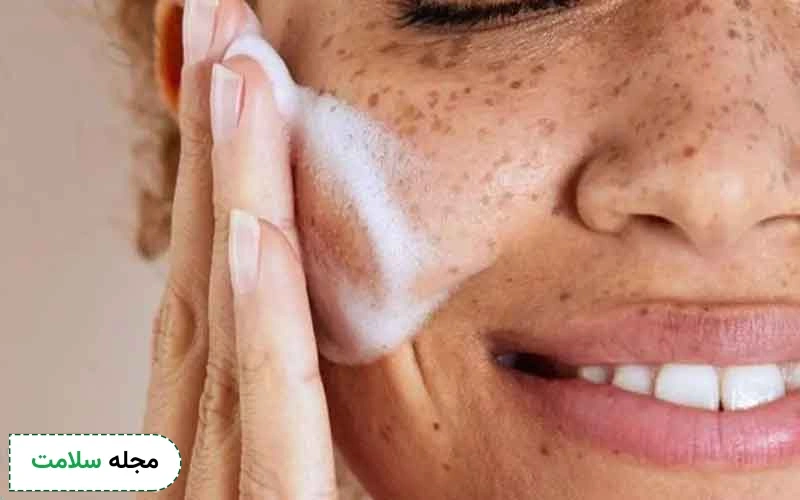 آشنایی با بهترین کرم برای لک قهوه ای صورت