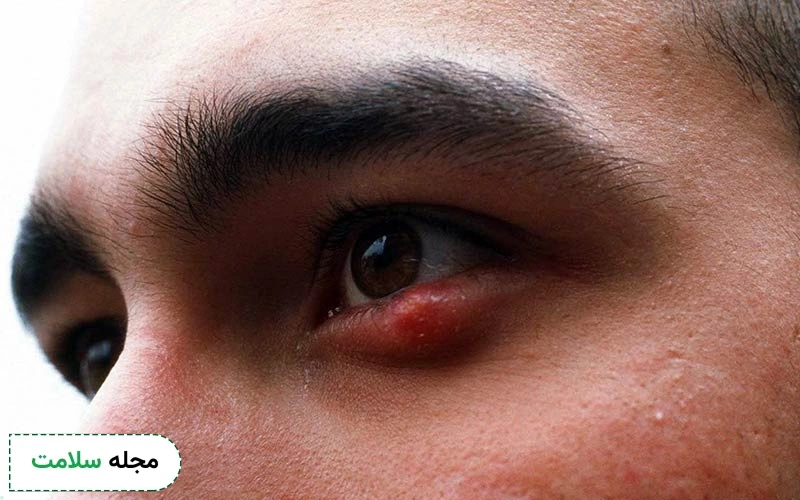 انواع پماد آنتی بیوتیک چشمی برای گل مژه وجود دارد.