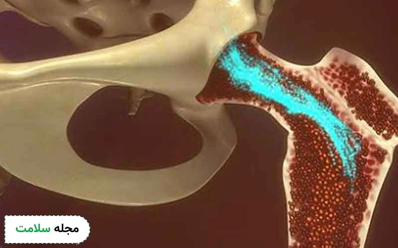 معرفی انواع قرص سرطان مغز استخوان