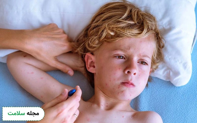 کدام قرص ضد خارش ابله مرغان تاثیر بیشتری دارد؟