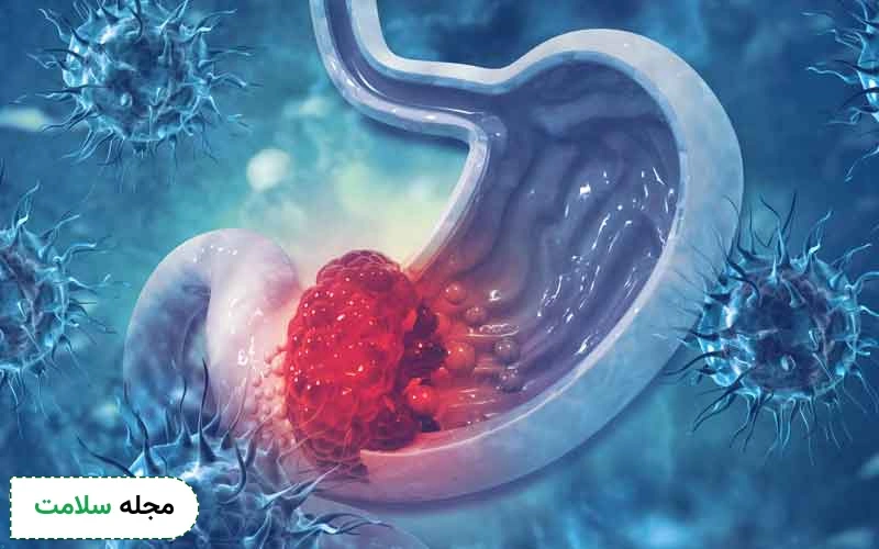 فواید داروهای سرطان معده خوش خیم چیست؟