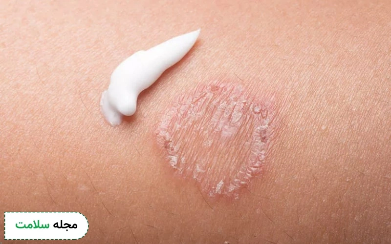 پماد الفا برای قارچ پوستی موثر است.