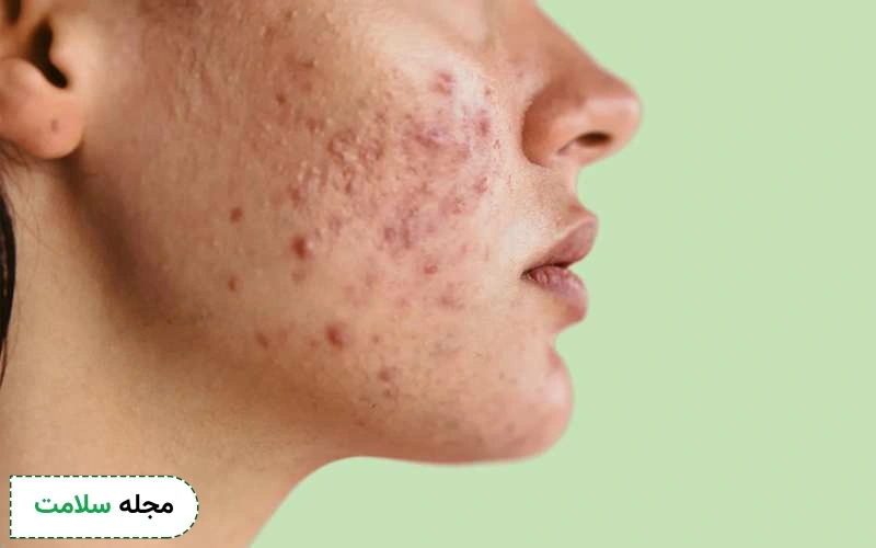 ژل پانژل برای جای جوش هم استفاده می شود؟