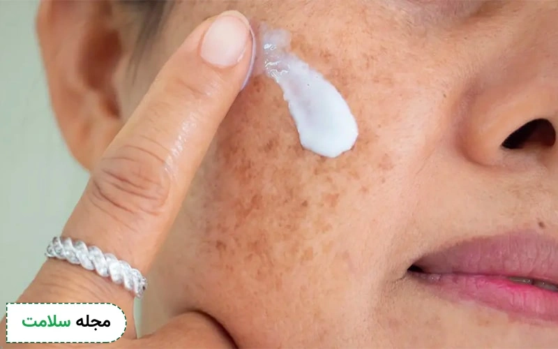 نحوه مصرف پماد آداپالن چگونه است؟