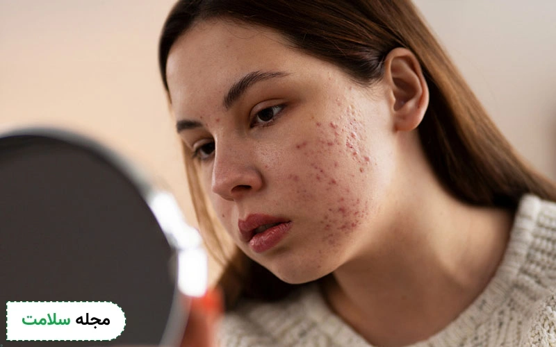 آزلائیک اسید برای درمان جوش چقدر موثر است؟