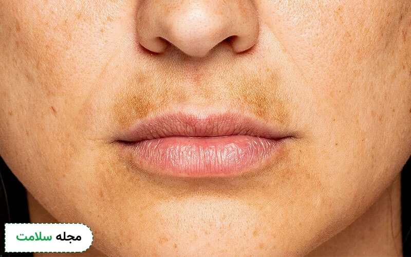 آزلائیک اسید برای درمان ملاسما و لکه‌های پوستی استفاده می شود. 