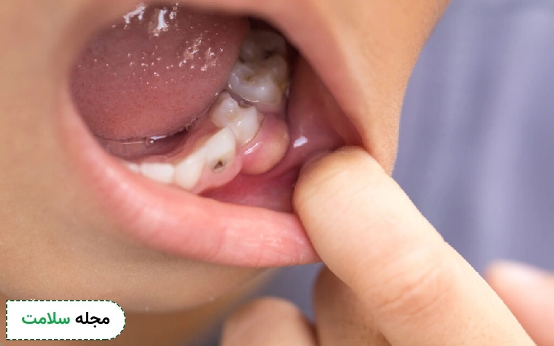 شربت مترونیدازول برای عفونت دندان کودکان هم تجویز می شود.