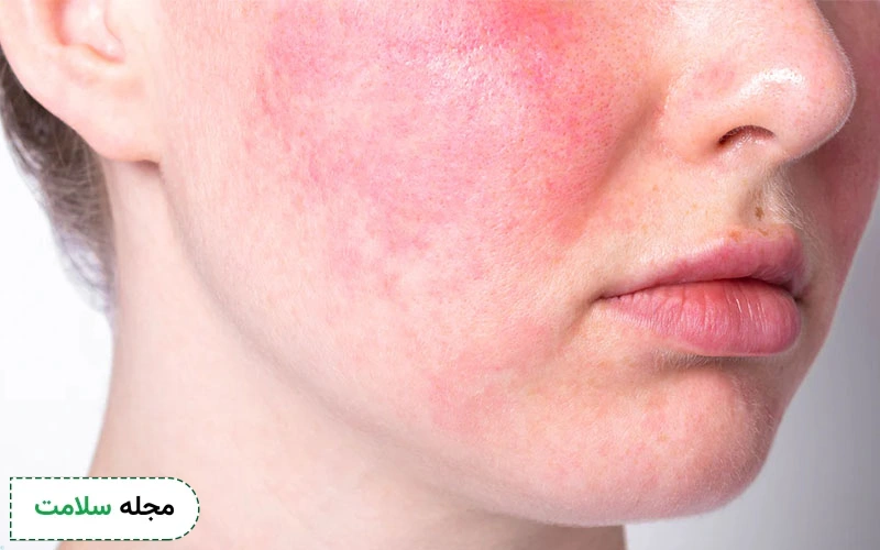 پماد آزلادرم برای درمان روزاسه موثر است.