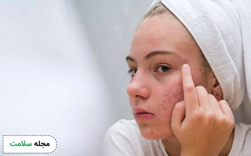 کرم پانژل چیست؟ این پماد در چه مواردی تجویز میشود؟