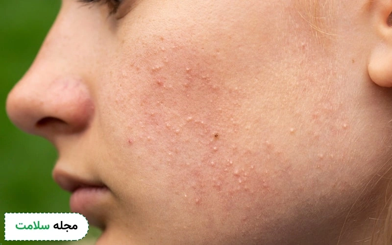 پماد آداپالن برای جای جوش مفید است.
