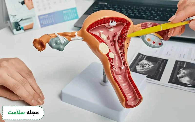 پروژستین برای درمان پولیپ رحم مفید است.