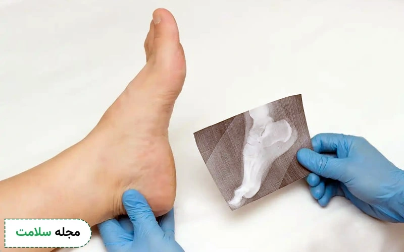 بهترین کرم برای خار پاشنه چیست؟