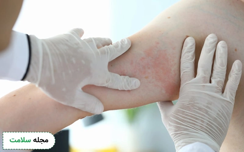 آیا پماد کورتون دار برای اگزما خوب است؟