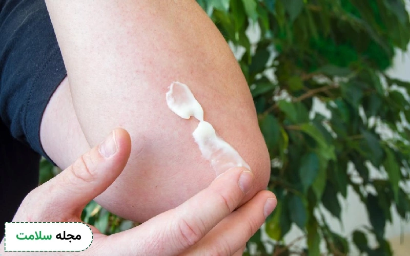 پماد کالاندولا و بتامتازون