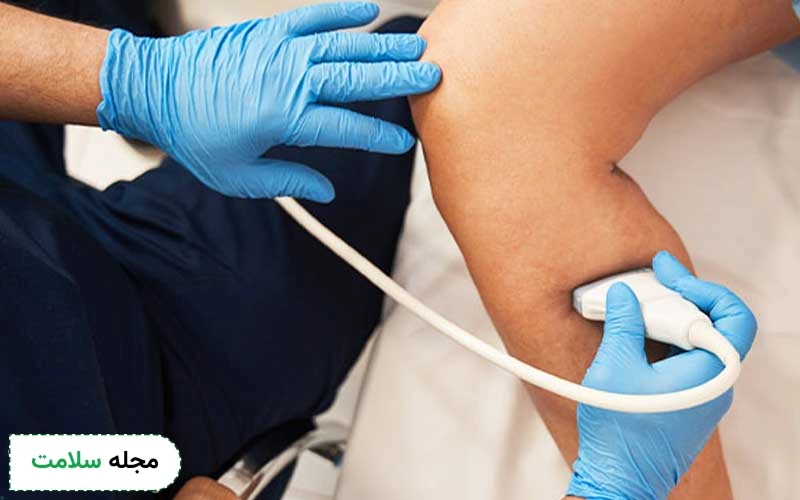 اقدامات موثر بعد از درمان با چسب واریس چیست؟