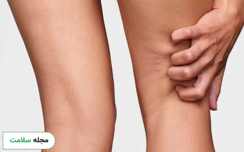 قرص برای خارش بدن