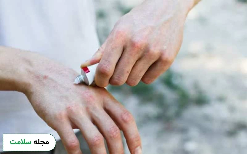 پماد آنترالین چیست و چه کاربردی دارد؟ آیا این کرم عوارض دارد؟