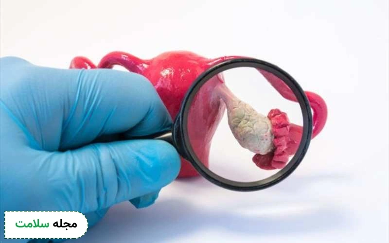 بهترین قرص برای تنبلی تخمدان و بارداری کدام است؟