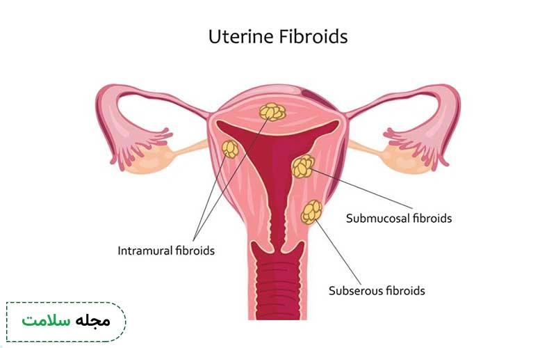 انواع موثرترین قرص برای فیبروم رحم کدامند؟ معرفی 23 قرص فیبروم رحم