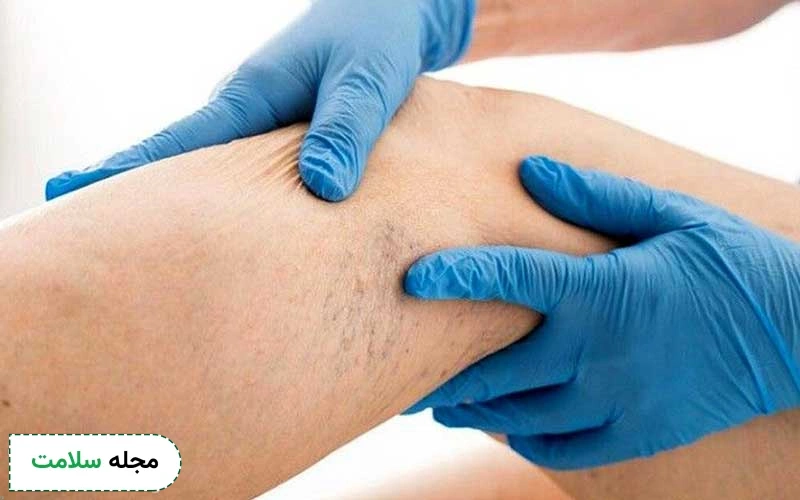 چسب واریس چیست؟