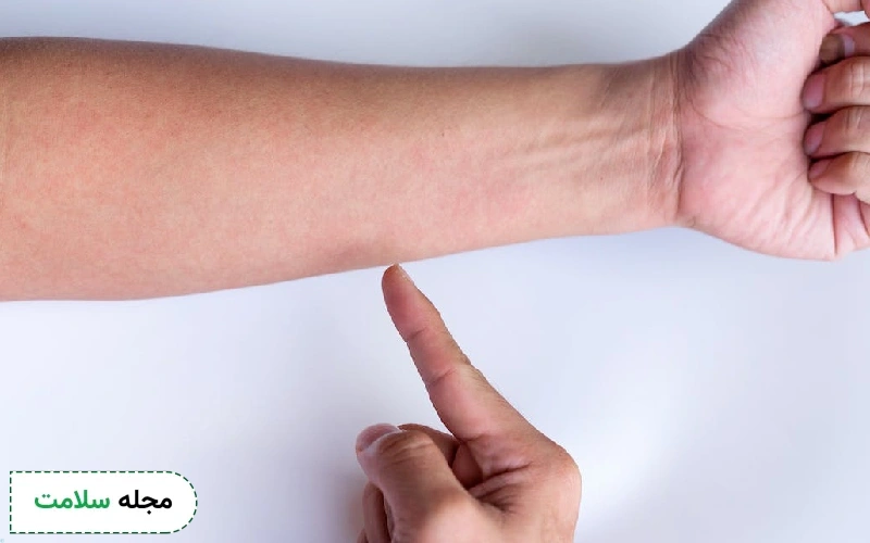 علائم حساسیت به پنی سیلین