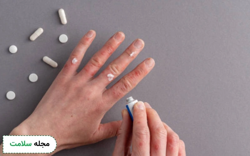 کرم خارش بدن چیست؟