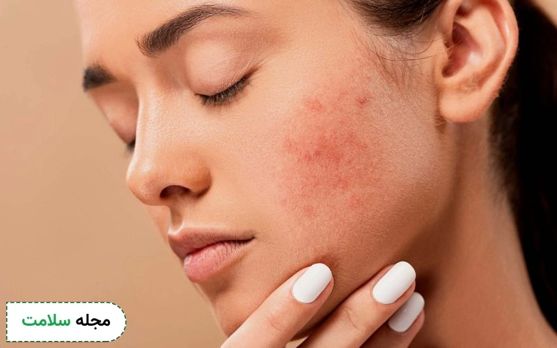 از پماد رکوبیزول برای جوش می توان استفاده کرد؟