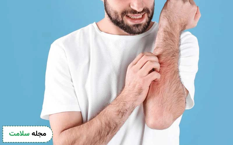 داروی گیاهی برای خارش بدن
