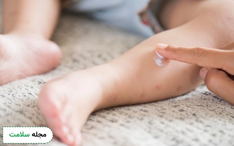 پماد کالامین برای آبله‌مرغان