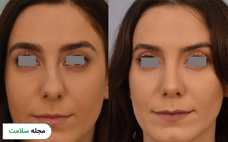 قرص آناهیل برای ورم بینی