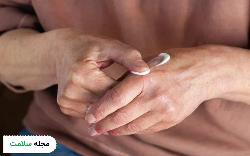 طریقه مصرف آنترالین به شدت پسوریازیس بستگی دارد.