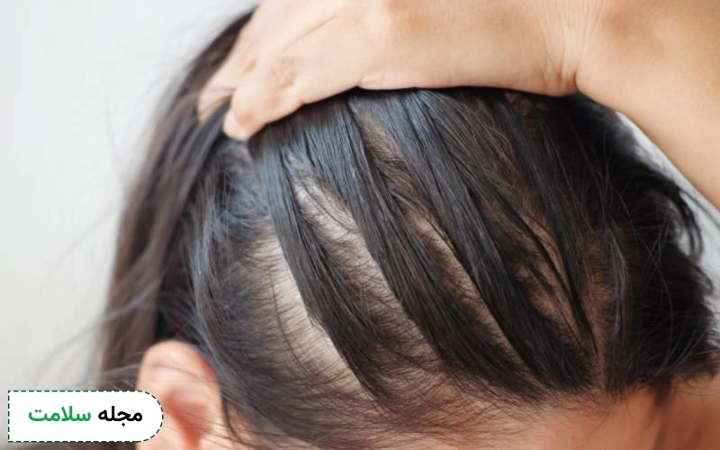 سیپروترون کامپاند از ریزش مو جلوگیری می کند.