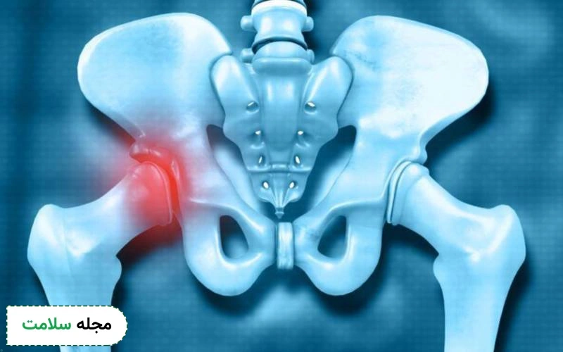 کمردرد پس از بی حسی اسپاینال چگونه است؟