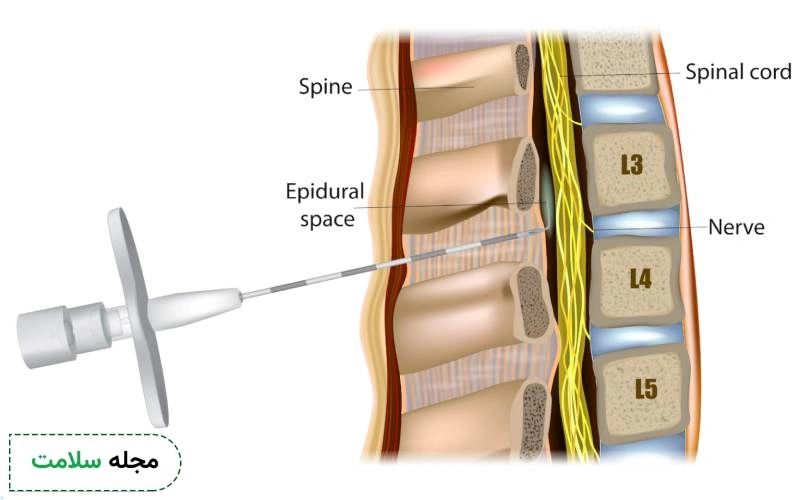 بی حسی نخاعی چند ساعت طول میکشد؟
