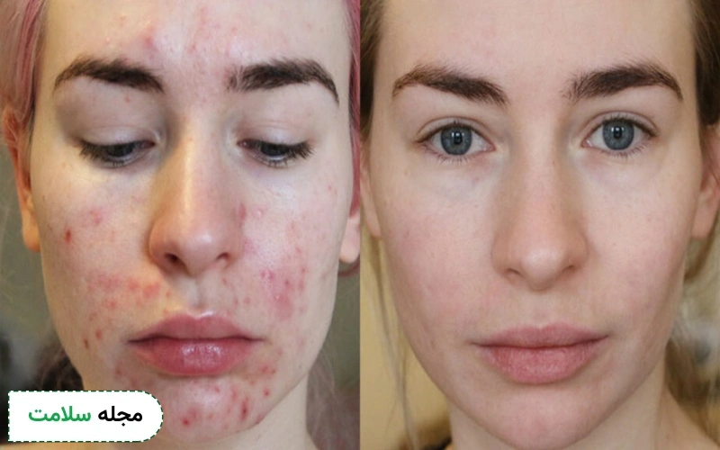 خواص قرص راکوتان چیست؟