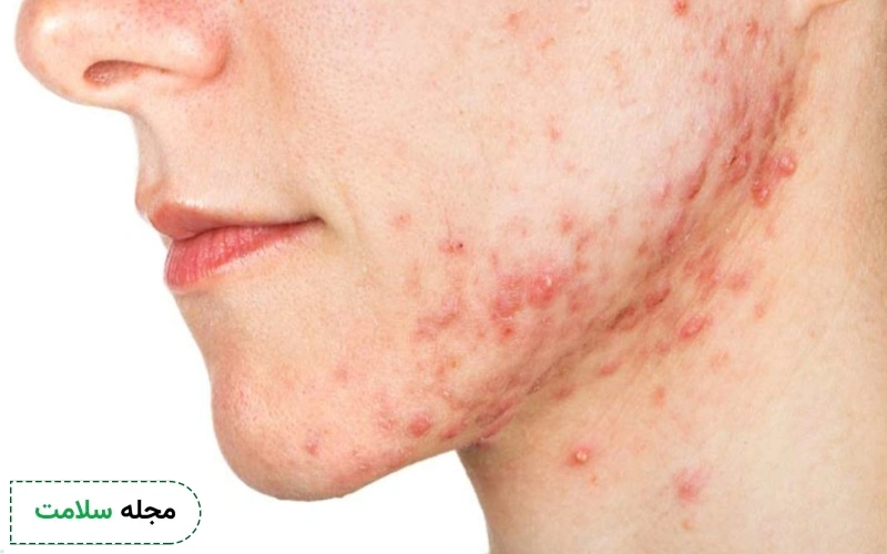 قرص راکوتان برای چه نوع جوشی است؟