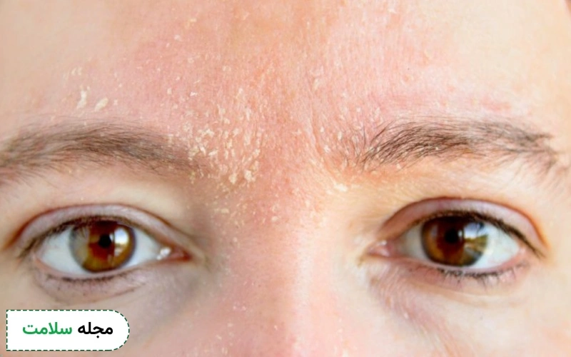 برای خشکی پوست بعد از مصرف راکوتان را چه کنیم؟