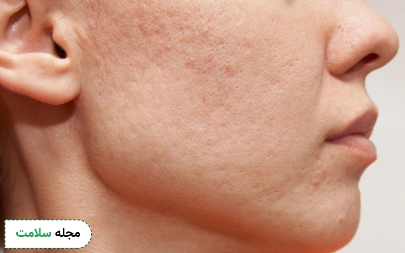 آیا برای درمان لک صورت هم کرم زینک اکساید مناسب است؟