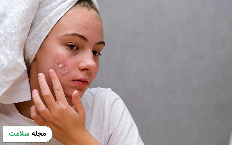 پماد موپیروسین برای جوش 