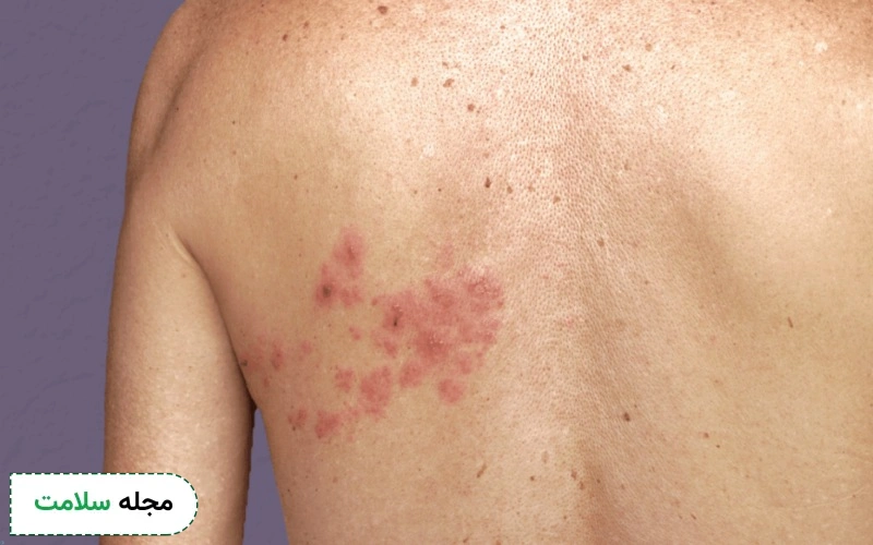 پرگابالین ۵۰ برای درمان زونا خوب است؟