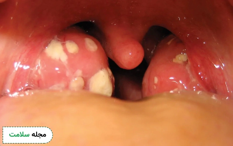 قرص آموکسی کلاو برای عفونت لوزه خوبه؟