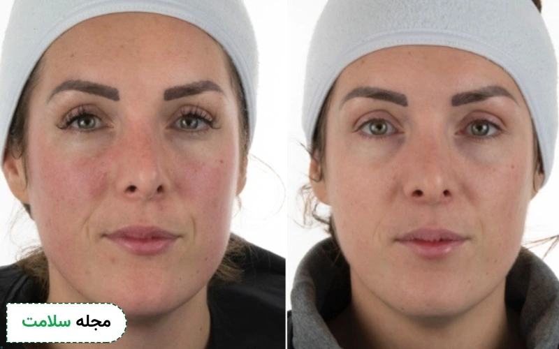 کرم یا ژل موضعی ترانگزامیک اسید چیست؟