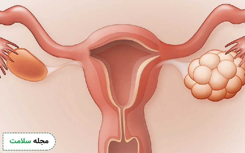 درمان سندروم تخمدان پلی کیستیک از چند طریق انجام می شود.