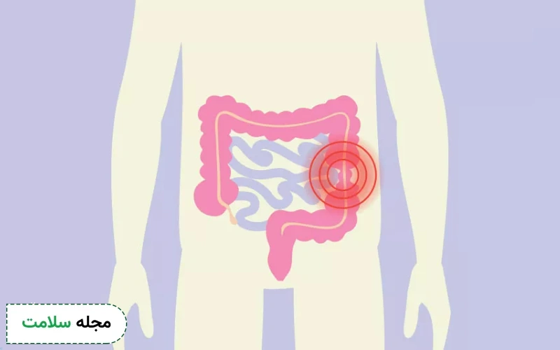 قرص دي سيكلومين برای سندروم روده تحریک پذیر