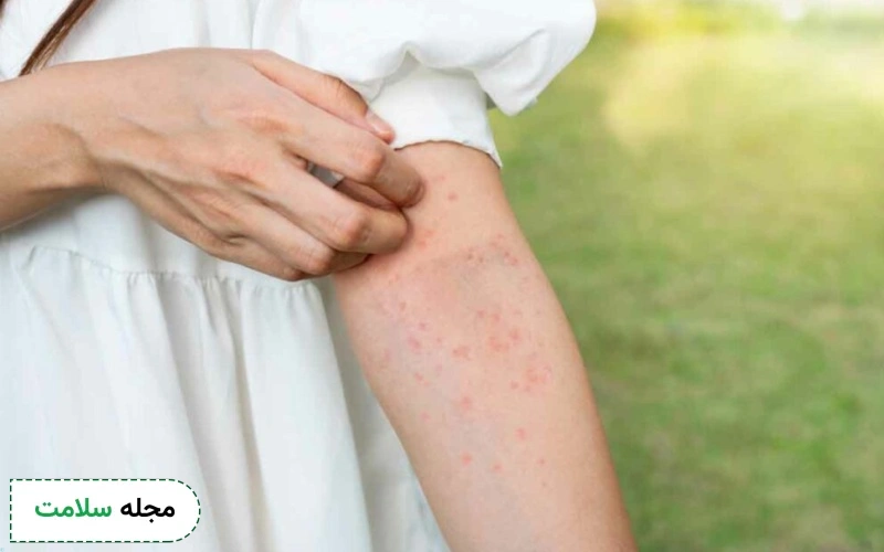 شربت سیتریزین برای چیست؟