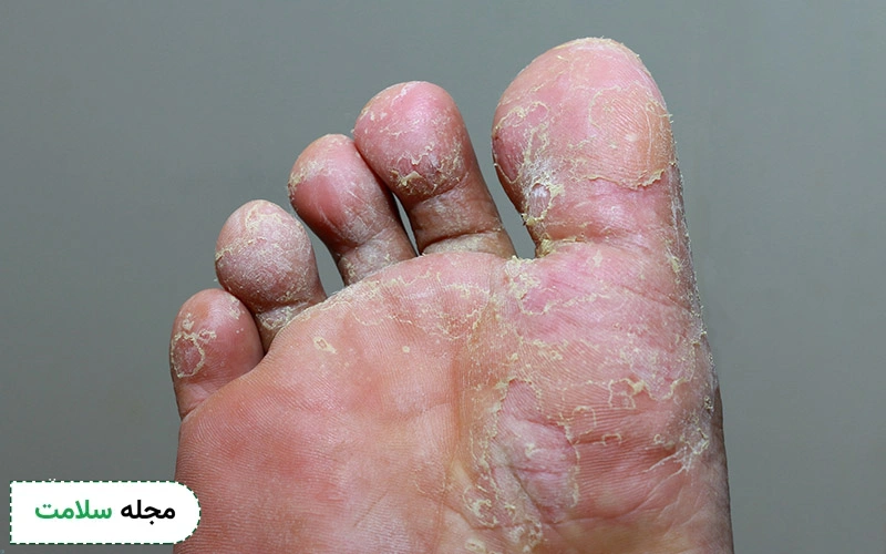 کلوتریمازول برای بیماری پای ورزشکار