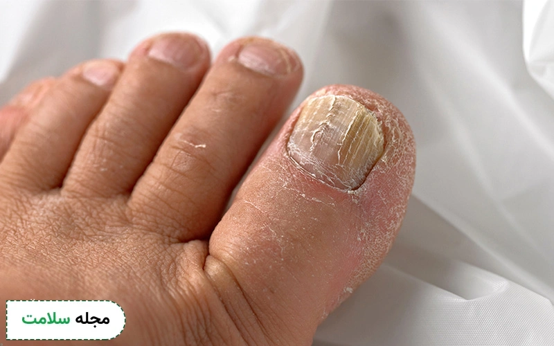 کلوتریمازول برای عفونت قارچی ناخن