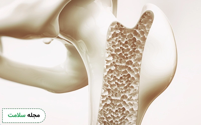 قرص آلندرونیت ۷۰ برای چیست؟