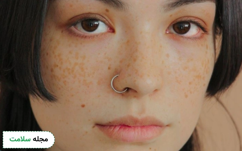 کرم هیدروکینون برای درمان لک و کک و مک خوب است؟